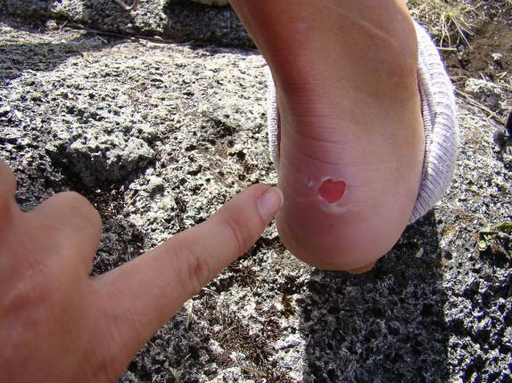 Bolha feita durante a subida da Pedra da Mina em Passa Quatro - MG Bolha feita durante a subida da Pedra da Mina em Passa Quatro - MG